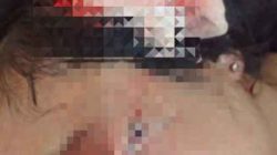 Ibu Rumah Tangga di Tanggamus Disayat Pisau Suami Siri, Luka Parah di Kepala dan Bahu